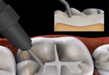 Jak leczyć próchnicę zębów?